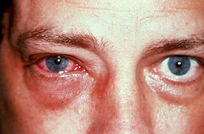 Отслойка стекловидного тела глаза: причины, лечение, симптомы, осложнения и профилактика