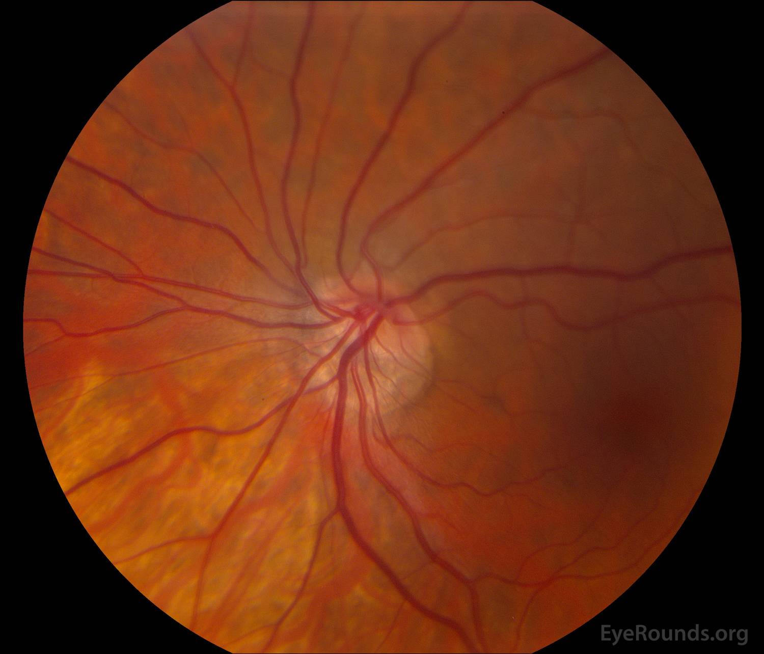 Неврит зрительного нерва: симптомы, лечение, причины, диагностика и осложнения