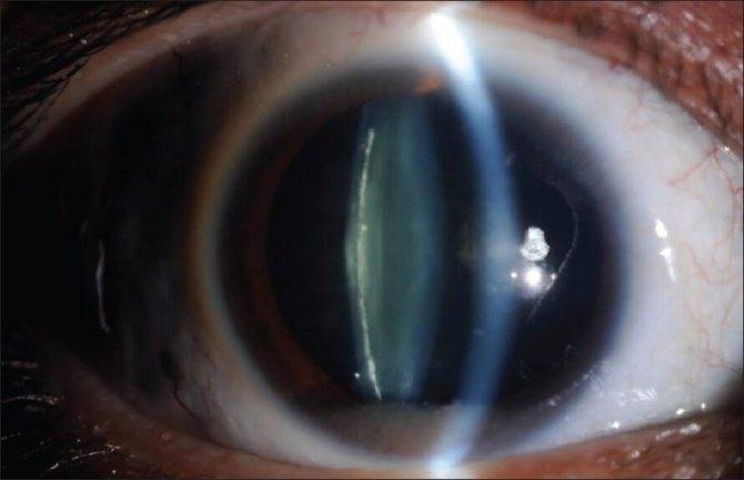 Врожденная катаракта у детей (точечная и другие виды заболевания), в том числе у новорожденных: код по мкб-10, причины возникновения, симптоматика, методы лечения