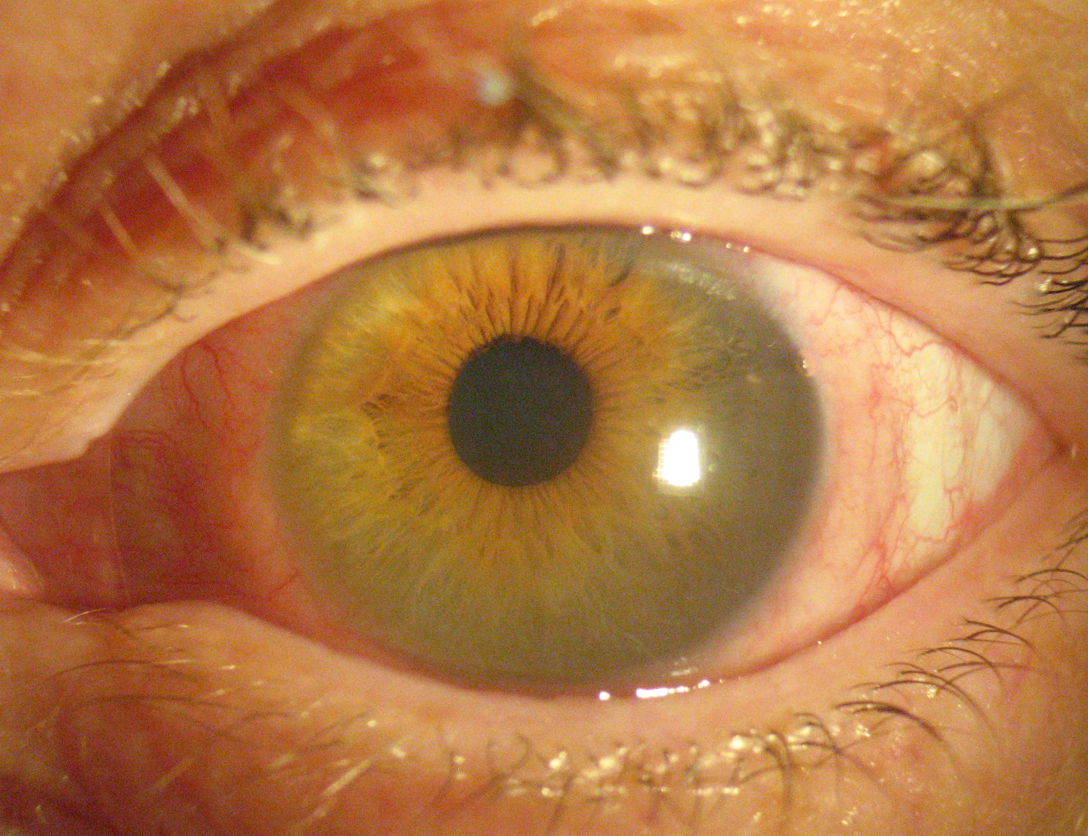 Причины и лечение царапины роговицы глаза