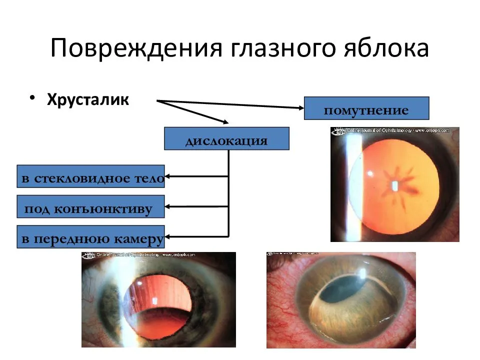 Нистагм глазного яблока: что это такое, причины возникновения разных видов заболевания, коррекция зрения и советы пациентам