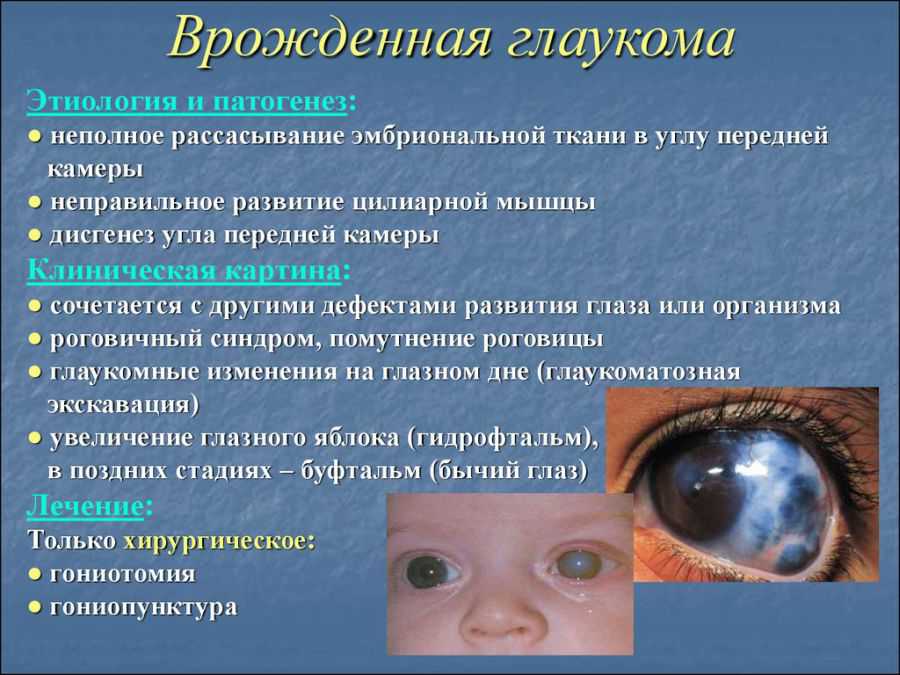 Глаукома: лечение, симптомы, причины и профилактика