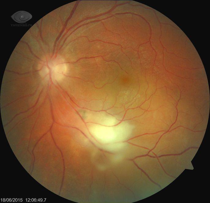 Разрыв сетчатки глаза - от чего бывает и как лечить патологию, ее причины и признаки, последствия и восстановление зрения