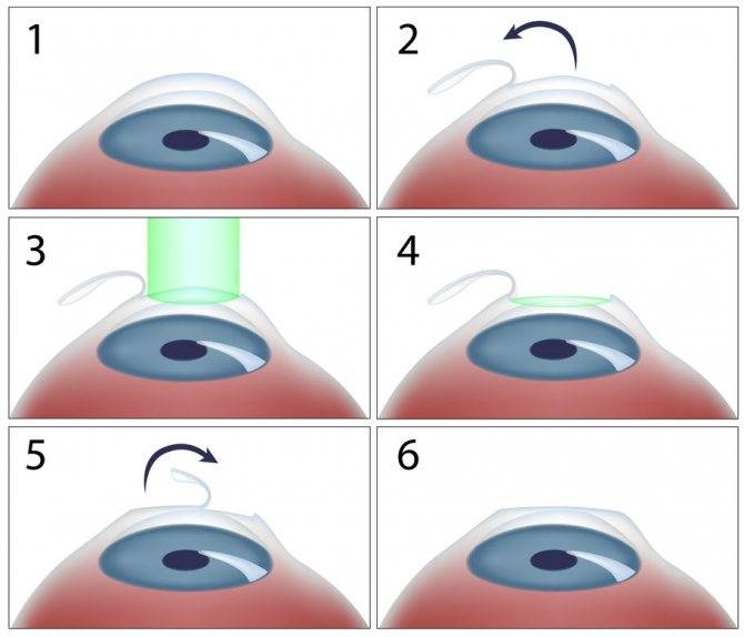 Лазерная коррекция зрения — так ли эффективен метод smile на самом деле? / хабр
