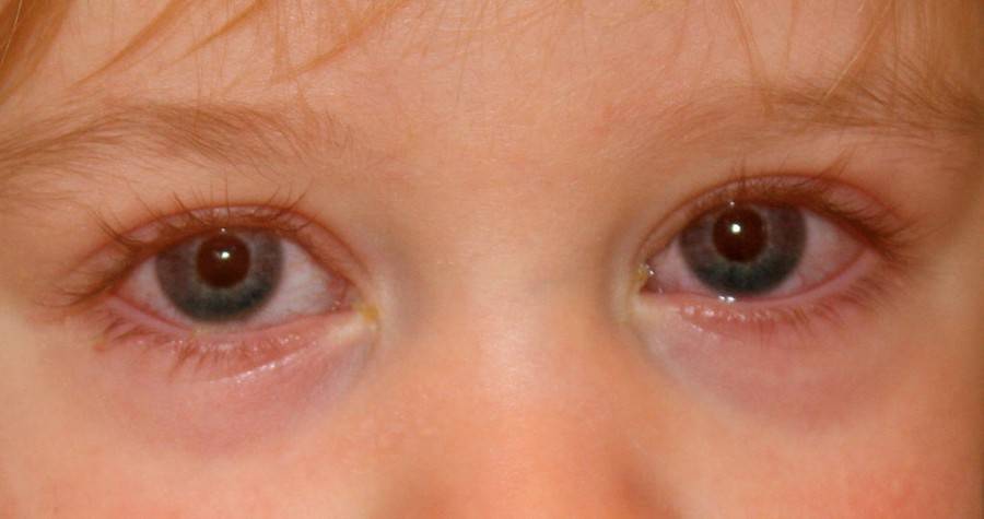 Острый конъюнктивит у детей: лечение глаз с воспалением, симптомы заболевания