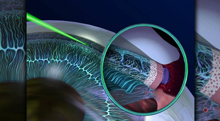 Селективная лазерная трабекулопластика слт | офтальмологический центр ophthalmica
