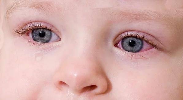 Красные веки у новорожденного после родов (сосуды, круги вокруг глаз): причины появления и  нужно ли показать грудничка врачу?