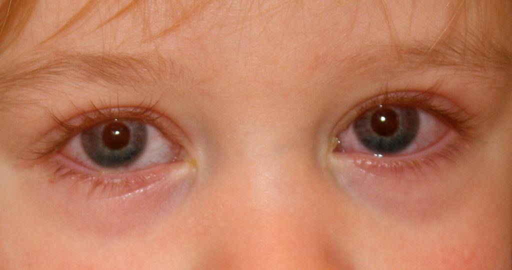 Аллергический конъюнктивит у детей (18 фото): симптомы и лечение ребенка, капли