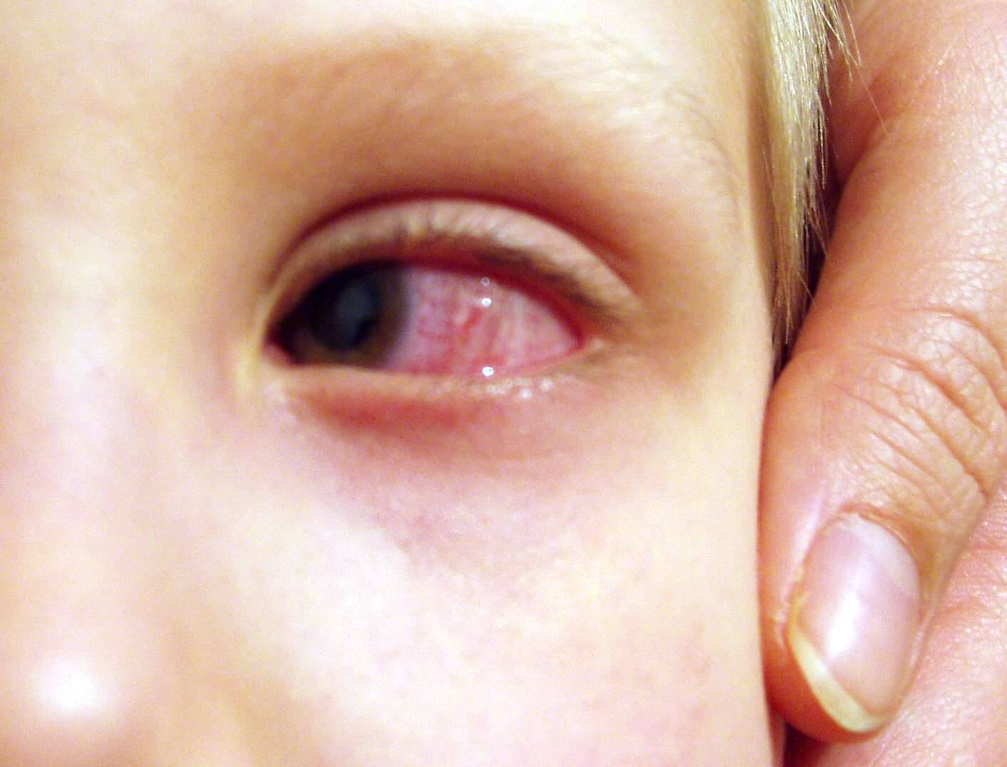 Гноятся глаза: что делать если киснут и чешутся, чем лечить гной у взрослого человека, причины и лечение, препараты если воспалился глаз
