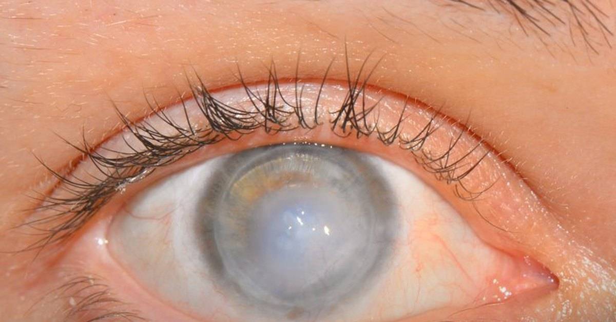 Резкое ухудшение зрения: причины, лечение и профилактика