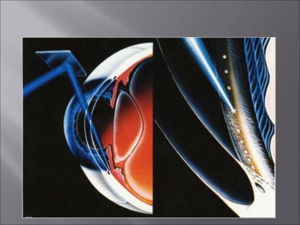 Как проводится лазерная трабекулопластика при глаукоме? — глаза эксперт