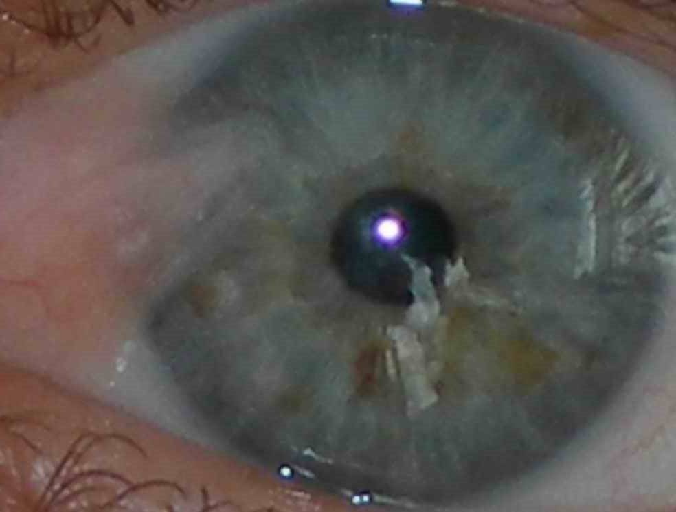 Деструкция стекловидного тела глаза: симптомы, лечение народными средствами, чем опасно, причины