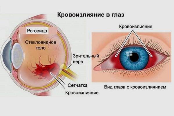 Что делать если в глазу лопнул капилляр: кровоизлияние в глаз - лечение, причины - нealthнacks