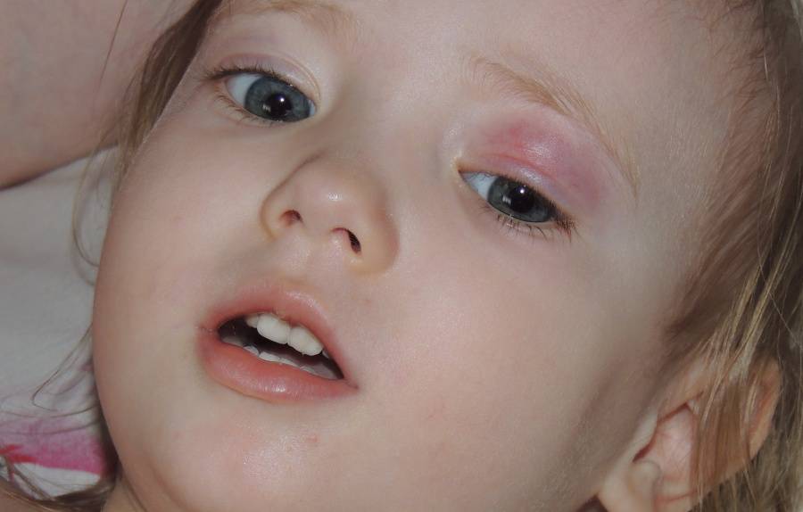 Халязион у детей (36 фото): лечение нижнего и верхнего века, причины болезни глаз по мнению доктора комаровского