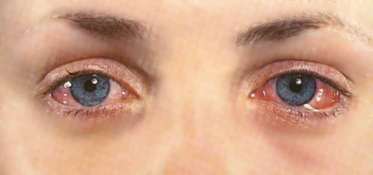 Глаза красные и чешутся: причины, лечение и профилактика