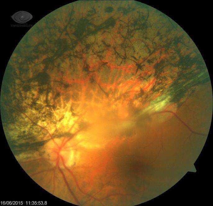 Дистрофия сетчатки глаза - симптомы, лечение, причины