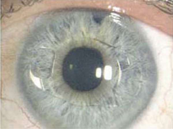 Причины для проведения артифакии глаза — рекомендации врачей
