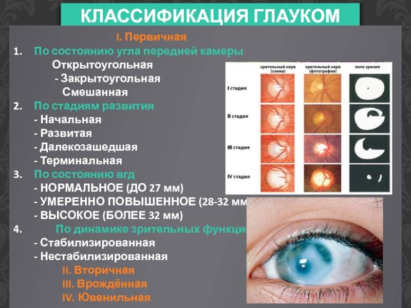 Степени глаукомы: 1, 2, 3 и 4 стадии