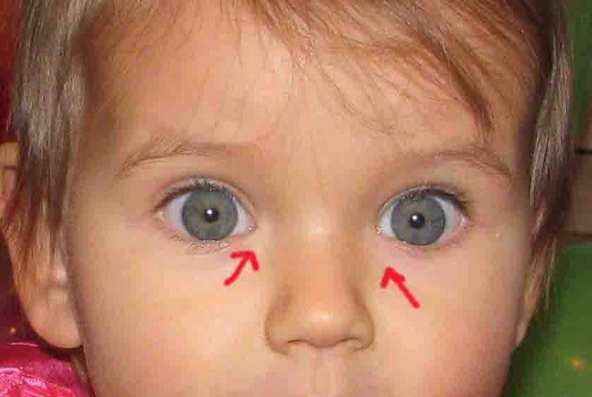 Что делать, если лопнул капилляр в глазу у ребенка – экстренная помощь