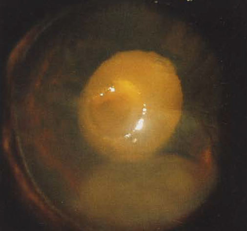 Вторичная пленчатая катаракта и фиброз задней капсулы хрусталика