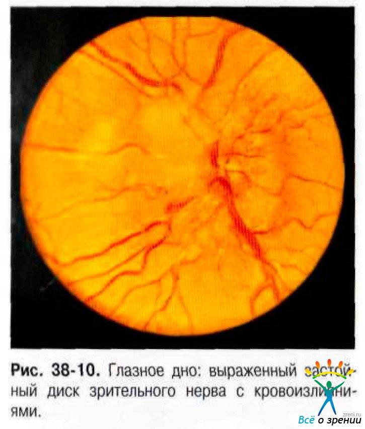 Застойный диск зрительного нерва (дзн) - причины, симптомы и лечение. рейтинг клиник, отзывы пациентов.