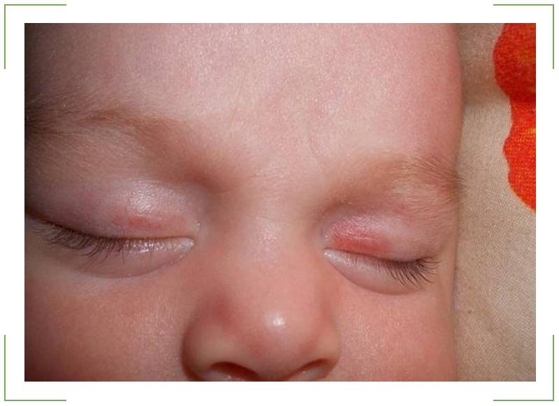 Красные белки глаз у ребенка: причины