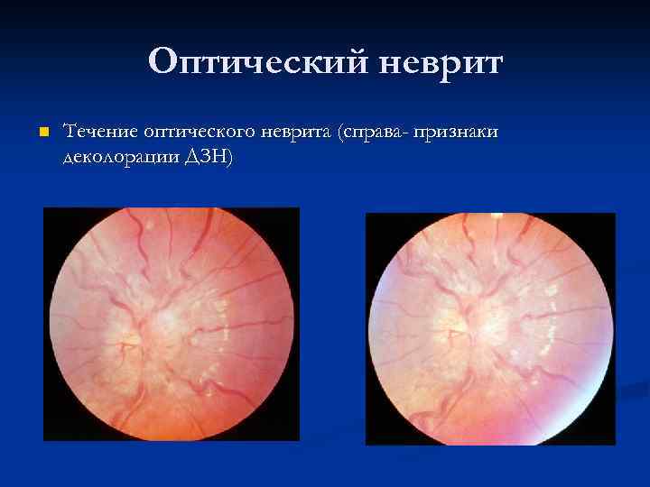 Неврит зрительного нерва: понятие, виды, лечение - "здоровое око"