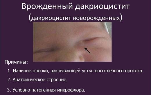 Массаж слезного канала у новорожденных: советы при дакриоцистите