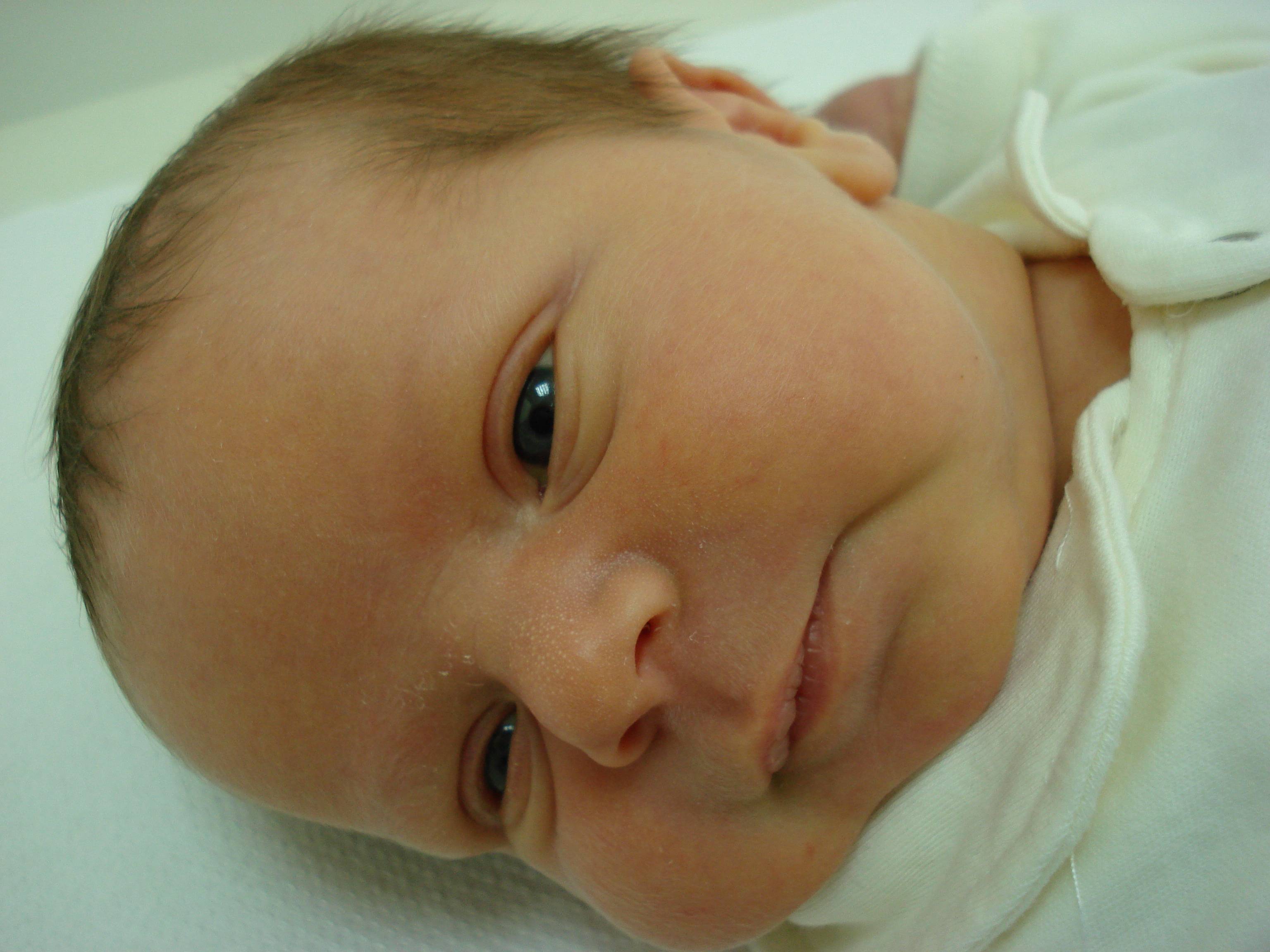 Желтые белки глаз у новорожденных: причины и симптомы, фото, лечение