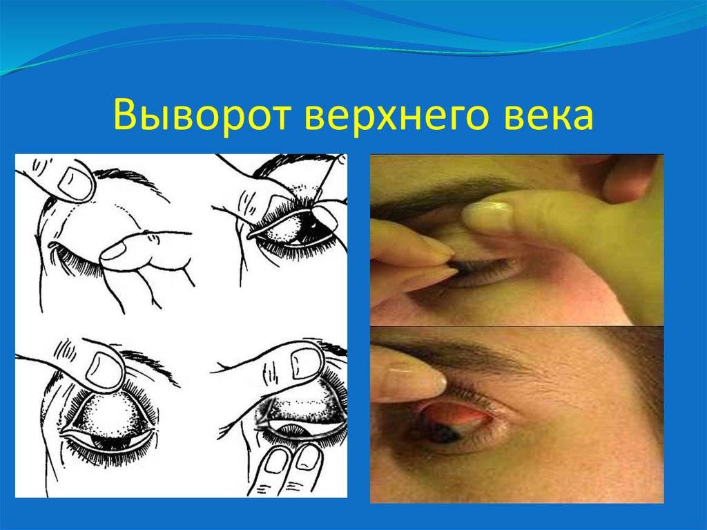 Выворот нижнего и верхнего века (эктропион глаза): исправление и лечение