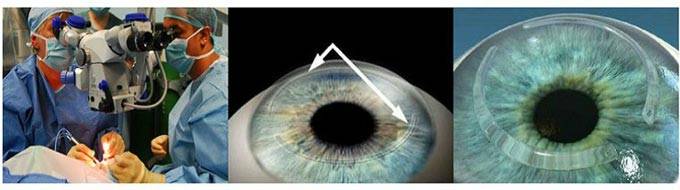 Осложнения и последствия после лазерной коррекции зрения
