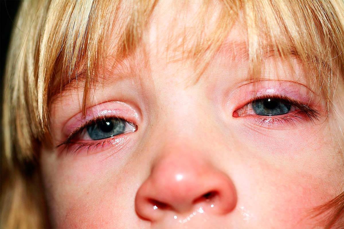 Как лечить народными средствами глаза покраснения у ребенка