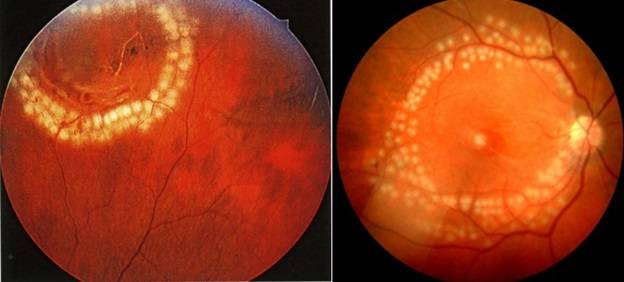Беременность и сетчатка - профилактическая перифирическая лазерная коагуляция сетчатки глаза