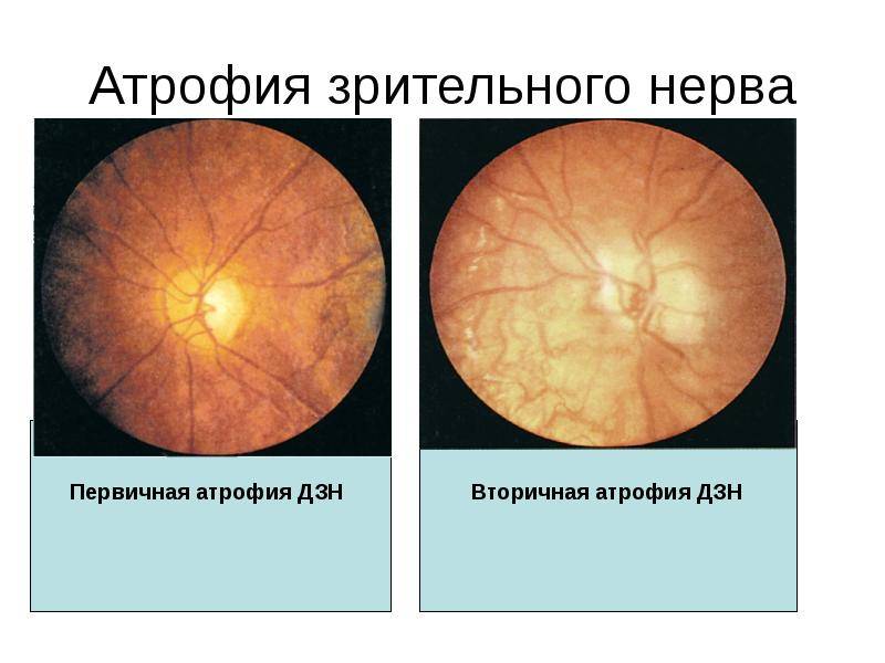Атрофия зрительного нерва: что это, симптомы и лечение