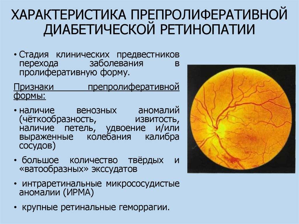 Диабетическая ретинопатия: симптомы, стадии, лечение