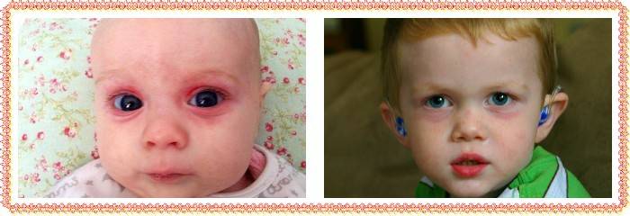 Мешки под глазами у ребенка 1 год и причины красных глаз
