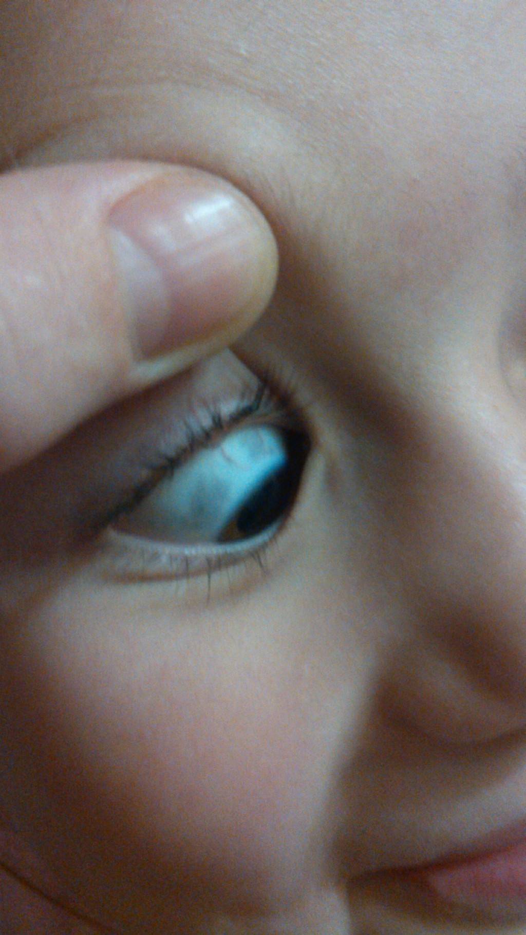 Серые уголки глаз у ребёнка - вопрос офтальмологу - 03 онлайн