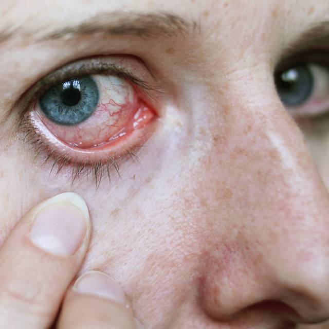 Онкология глаза: первые симптомы рака глаза