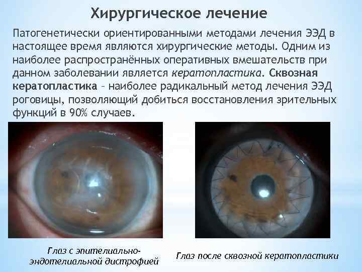 Дистрофия роговицы глаза: причины и симптомы - "здоровое око"