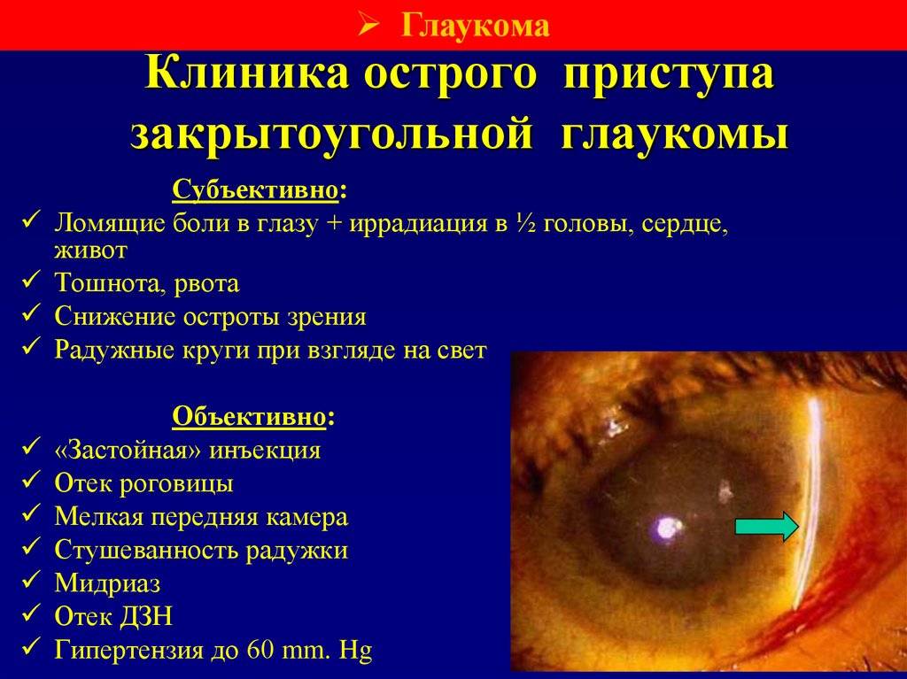 Острый приступ глаукомы