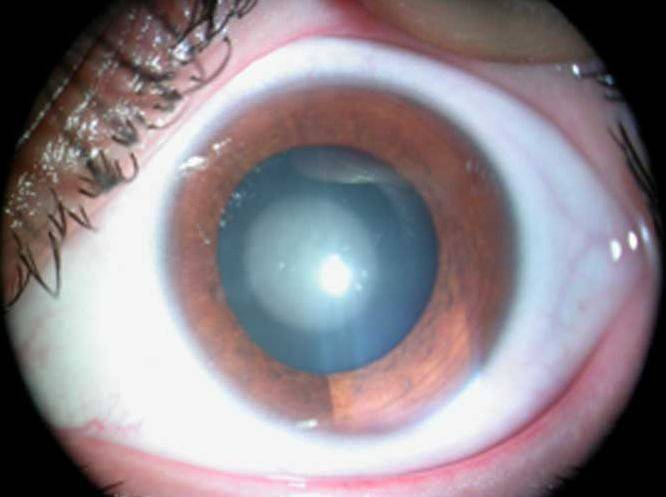 Все о катаракте глаза: причины, симптомы, лечение и профилактика | новости