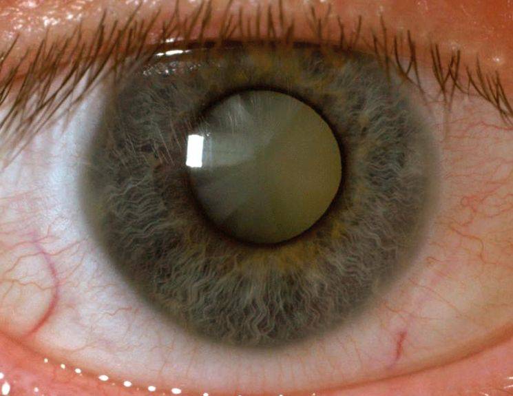 Помутнение роговицы: симптомы и лечение - "здоровое око"