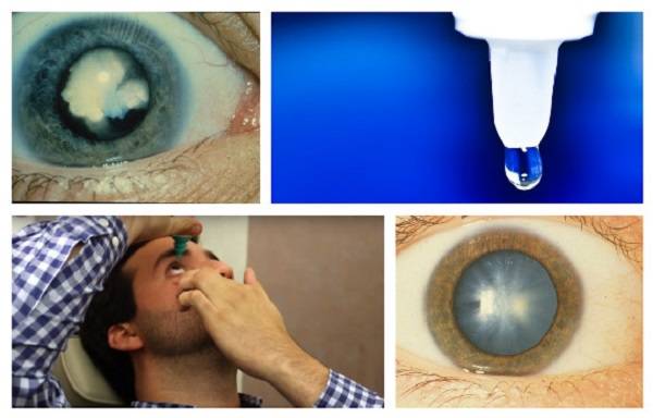 Глаза требуют отдыха: какие работы запрещены после операции по удалению катаракты