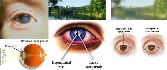 Диплопия (двоение в глазах): симптомы и причины - "здоровое око"