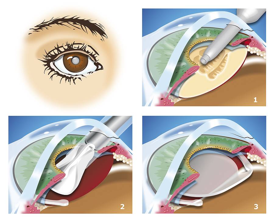 После удаления катаракты видно края линзы - катарактынет
