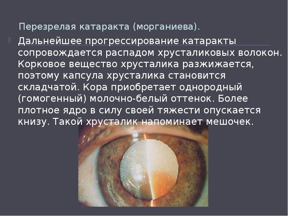 Начальная старческая катаракта. Миопизирующая катаракта. Переднекапсулярная катаракта. Катаракта перезрелая стадия.