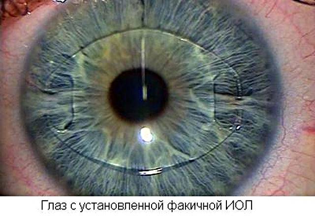 Артифакия: что это за вид операции, как она помогает лечить глаз и какие бывают виды хрусталиков