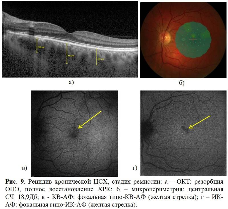 Центральная серозная хориоретинопатия глаза: лечение, симптомы, причины и осложнения