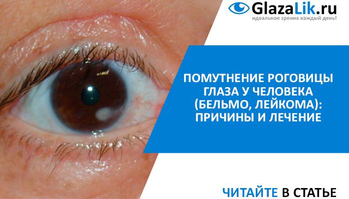 Бельмо на глазу: причины возникновения и как лечить глаз