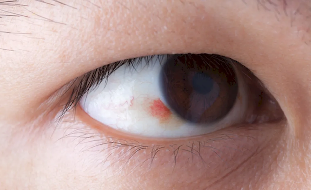 Красные круги под глазами у ребенка: что это, причины почему появляется краснота и пятна, комаровский - что делать